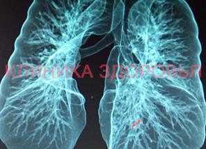 Кт с контрастированием легких Кт с контрастированием легких