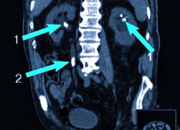 Кт мочевыделительной системы