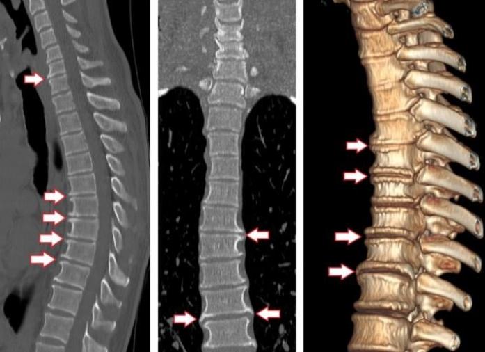 Кт грудного отдела позвоночника Кт грудного отдела позвоночника
