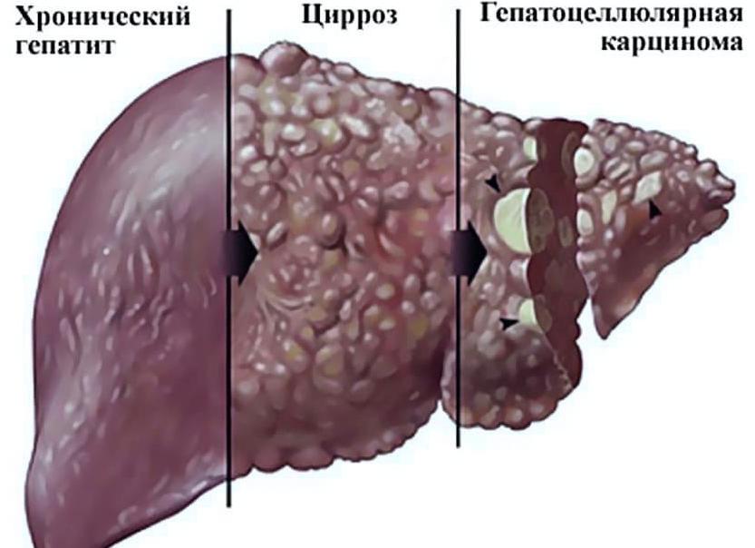 Что такое алкогольный гепатит