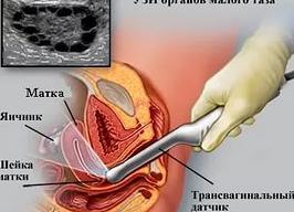 Цервикометрия как делают