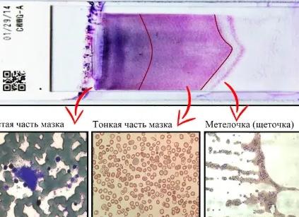 Анизоцитоз микро незначительный что это такое Анизоцитоз микро незначительный что это такое