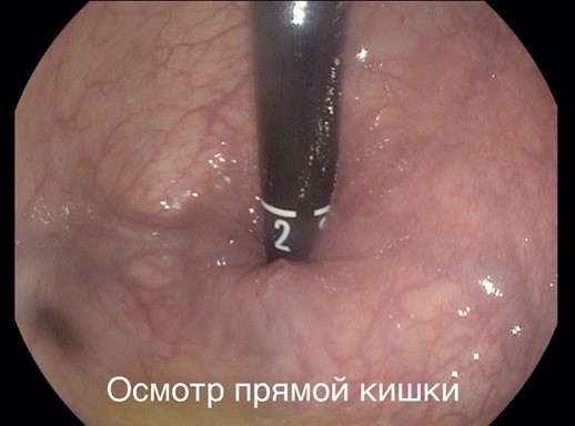 Как называется исследование прямой кишки