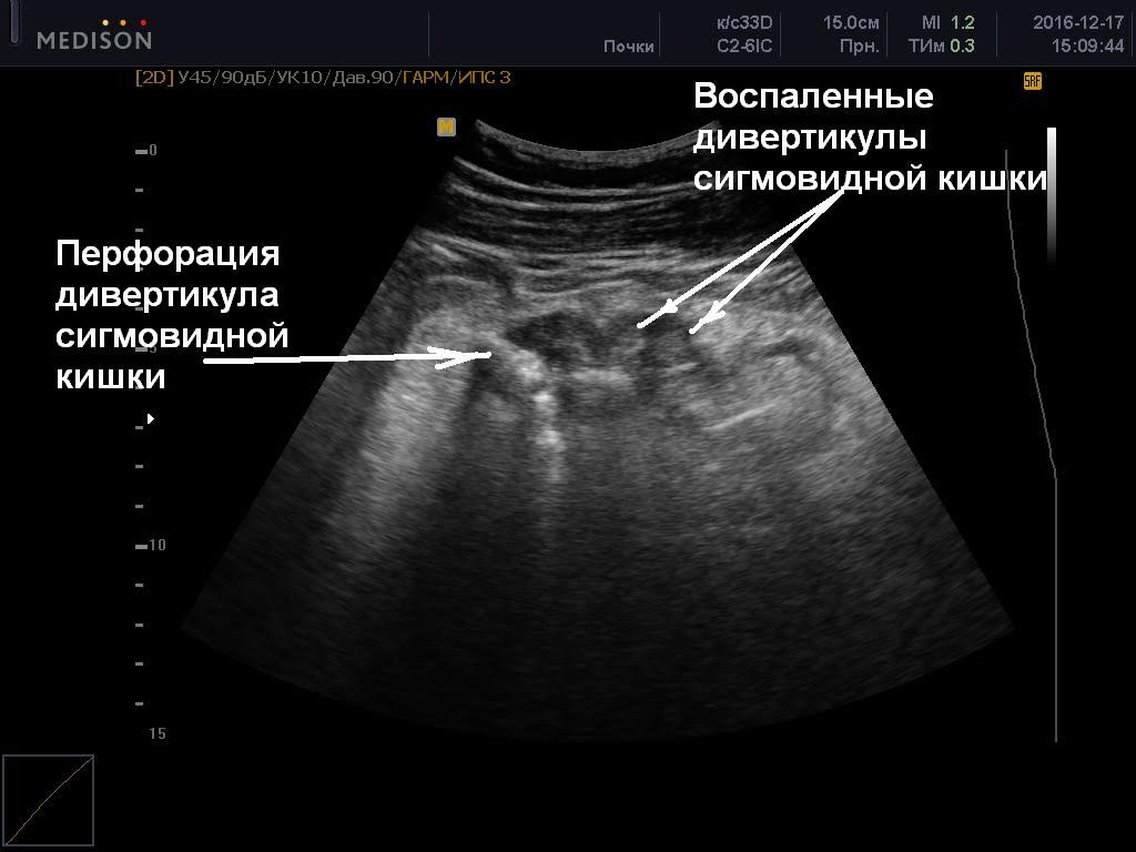 Как проверить кишечник на узи