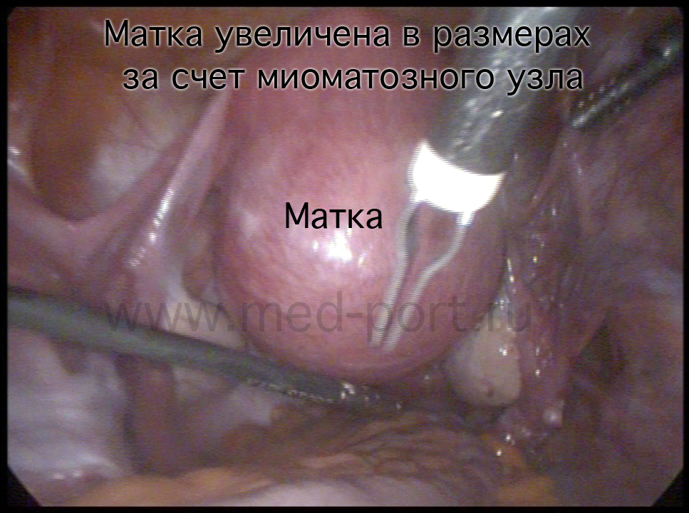 Как выглядит миома