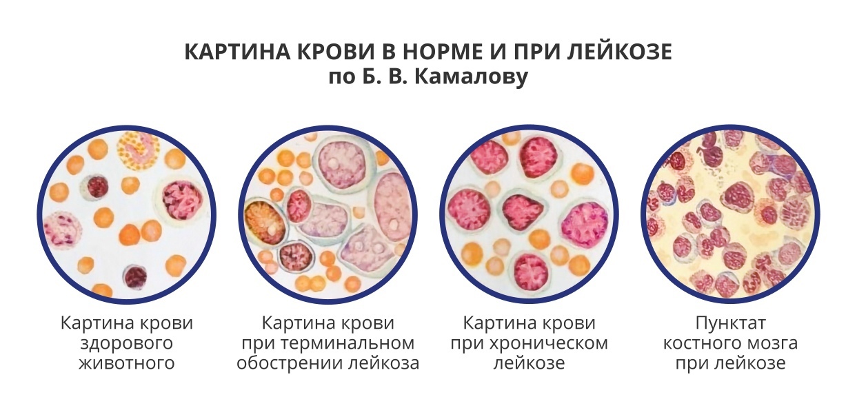 Кровь при лейкозе