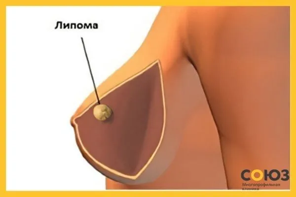 Липома в груди
