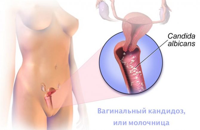 Молочница что это у мужчин