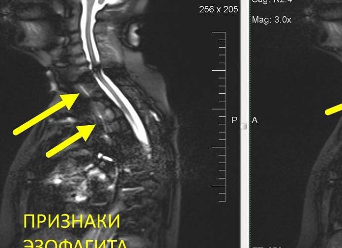 Мрт пищевода что показывает