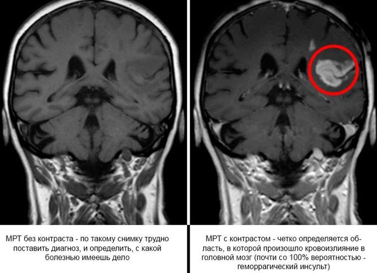 Мрт головы с контрастом