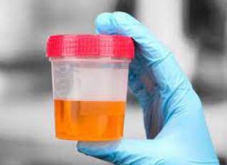 Моча темного цвета у ребенка причины Моча темного цвета у ребенка причины