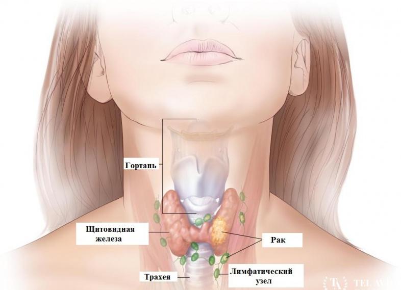 Медуллярный рак щитовидной железы
