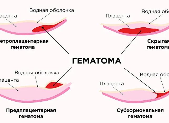 Кровянистые выделения причины Кровянистые выделения причины