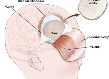 Кисты головного мозга у взрослых