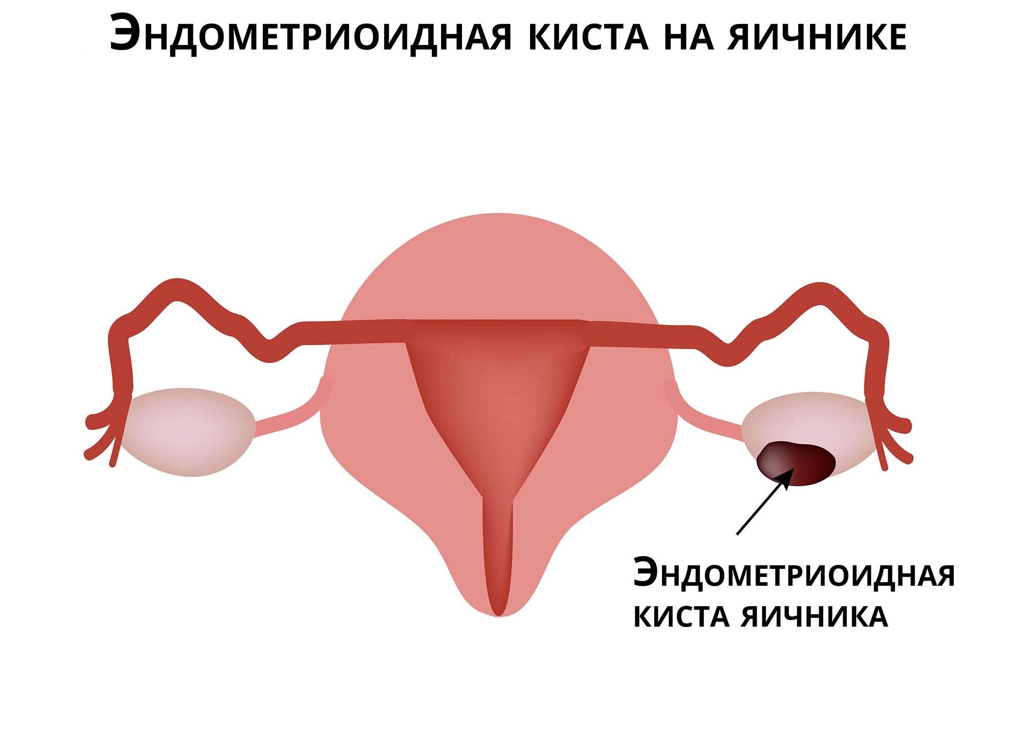 Киста яичника эндометрическая