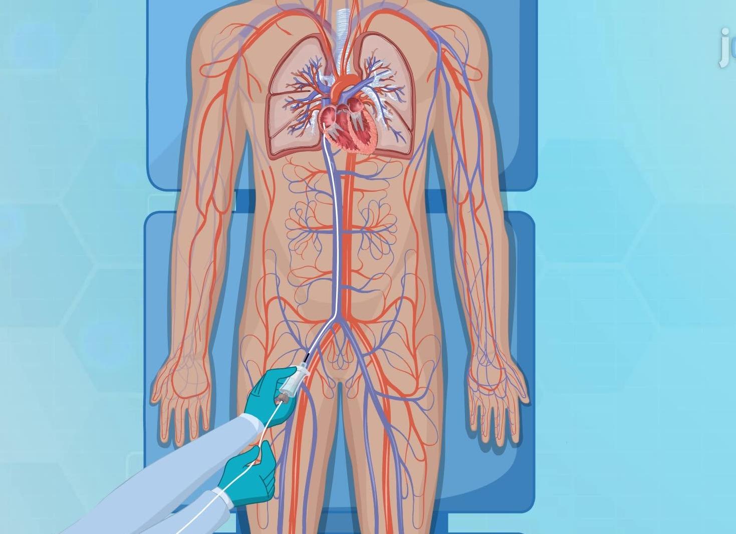 Кардиография сосудов сердца с контрастным веществом