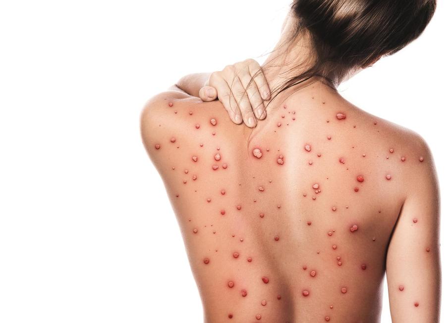 Как называется заражение крови