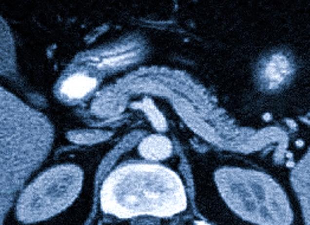 Размеры поджелудочной железы в норме головка тело хвост