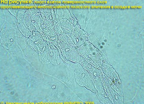 Эпителий плоский в моче у грудничка