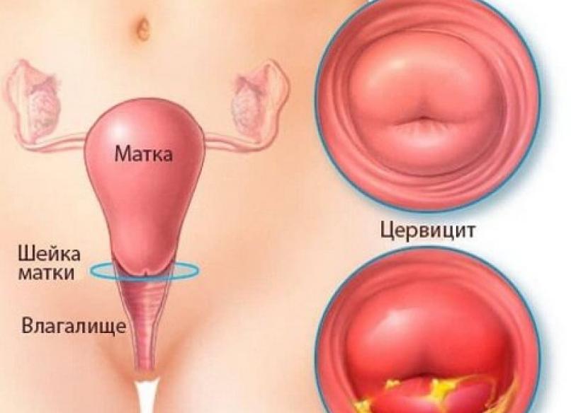 Эндоцервикс что это