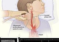 Дуплекс сосудов головы