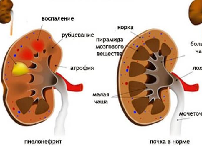 Болит почка узи в норме