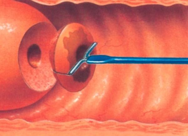 Биопсия шейки матки ножевая