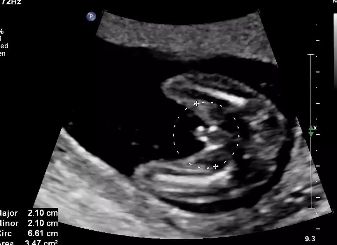 20 недель фото узи мальчика