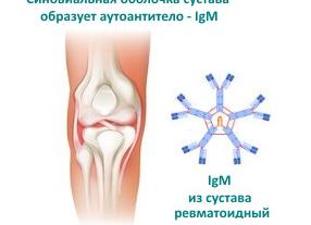 Анализ крови на ревматоидный фактор