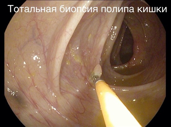Как смотрят кишечник изнутри