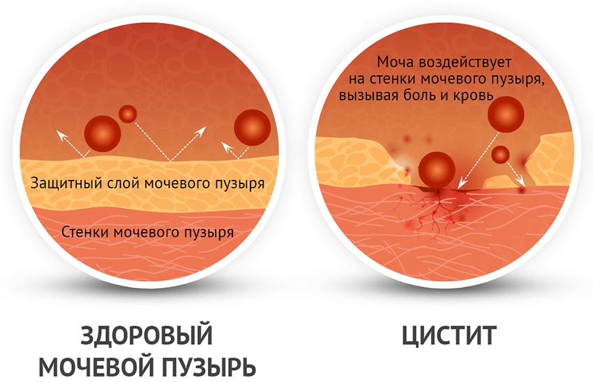 Какие анализы сдавать при цистите женщинам