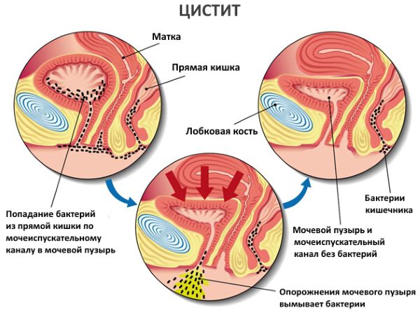 Кровь в моче при цистите
