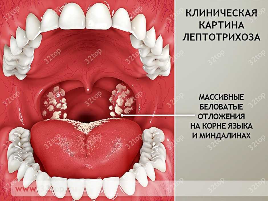 Лептотрикс чем лечить