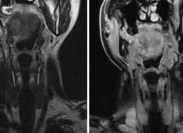 Мрт щитовидной железы что показывает Мрт щитовидной железы что показывает