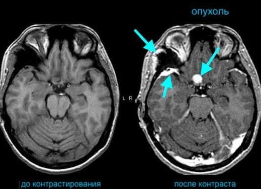 Кт без контраста что показывает Кт без контраста что показывает