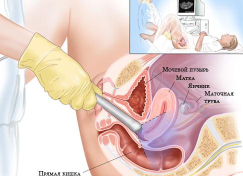 Как подготовиться к гинекологическому узи Как подготовиться к гинекологическому узи