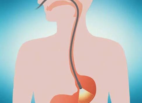 Гастроскопия без глотания зонда