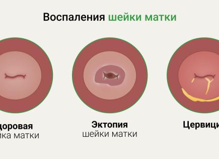 Если выделения пахнут луком