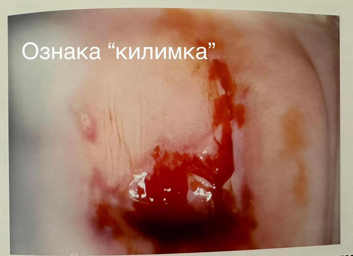 Эрозия шейки кровит
