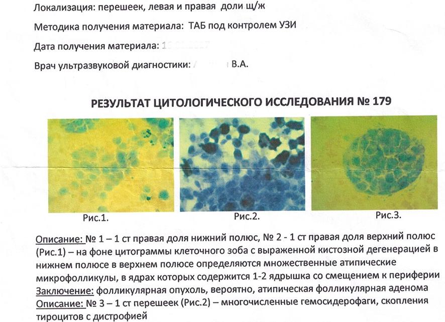 Цитология щитовидной железы расшифровка