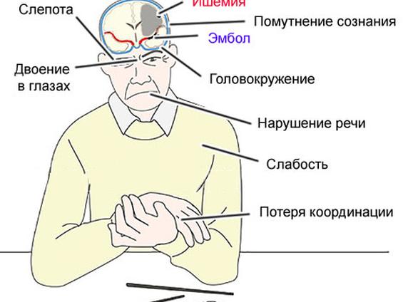 Что такое ишемия головного мозга и как лечить