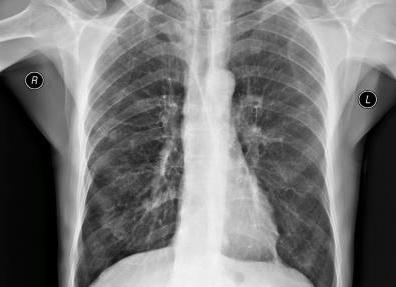 Что показывает рентген грудной клетки