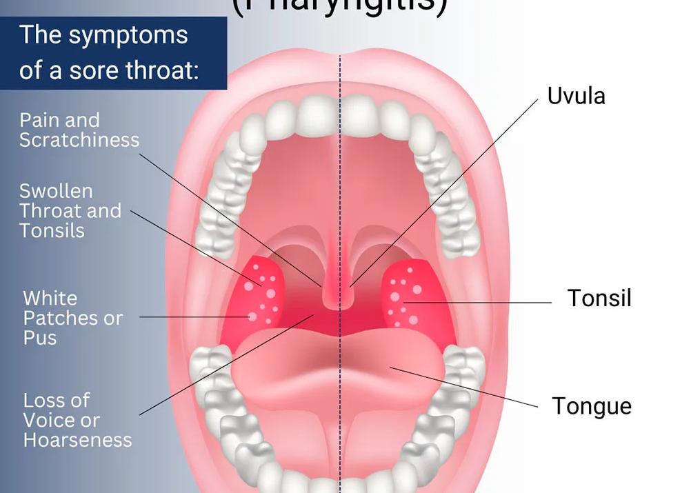 Чем лечить стрептококковую инфекцию в горле Чем лечить стрептококковую инфекцию в горле