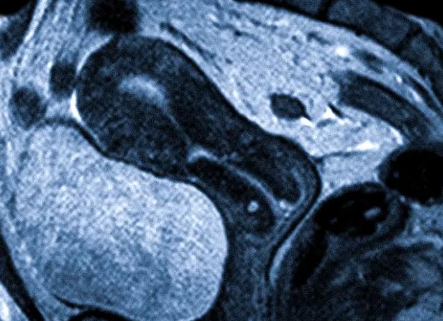 Мрт рубца на матке