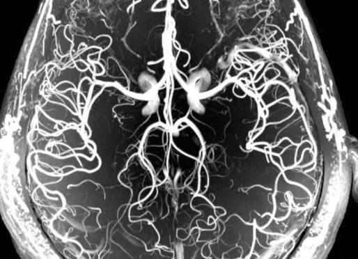 Мрт головного мозга вен и артерий