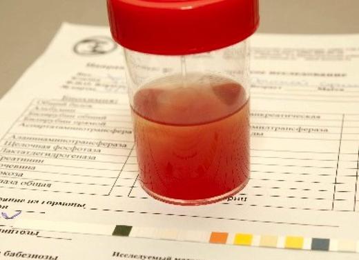 Моча красного цвета у женщины причины