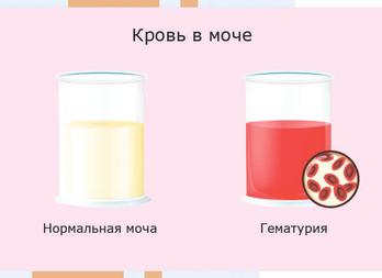 Моча цвета мясных помоев наблюдаются при Моча цвета мясных помоев наблюдаются при