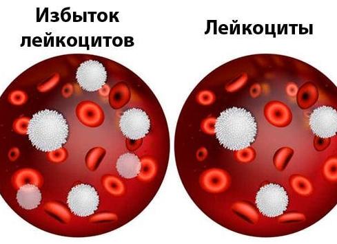 Лейкоцитоз что это такое у детей