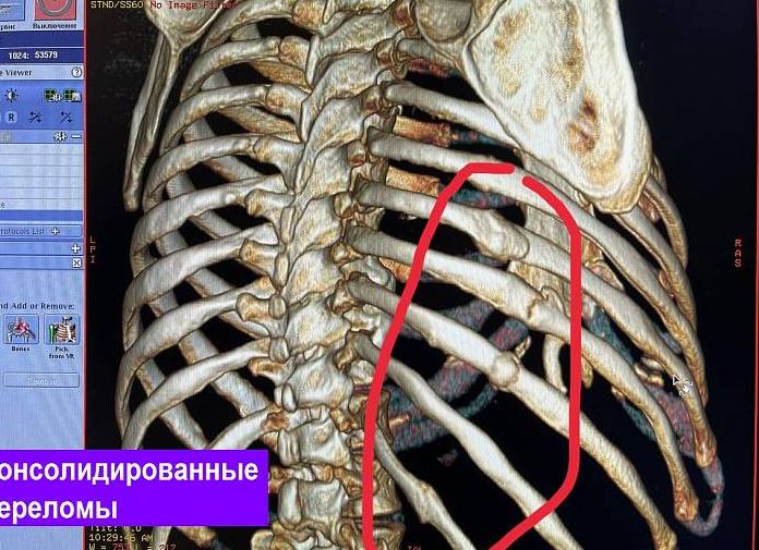 Кт органов грудной клетки