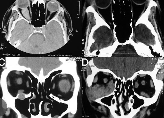 Кт глазных орбит